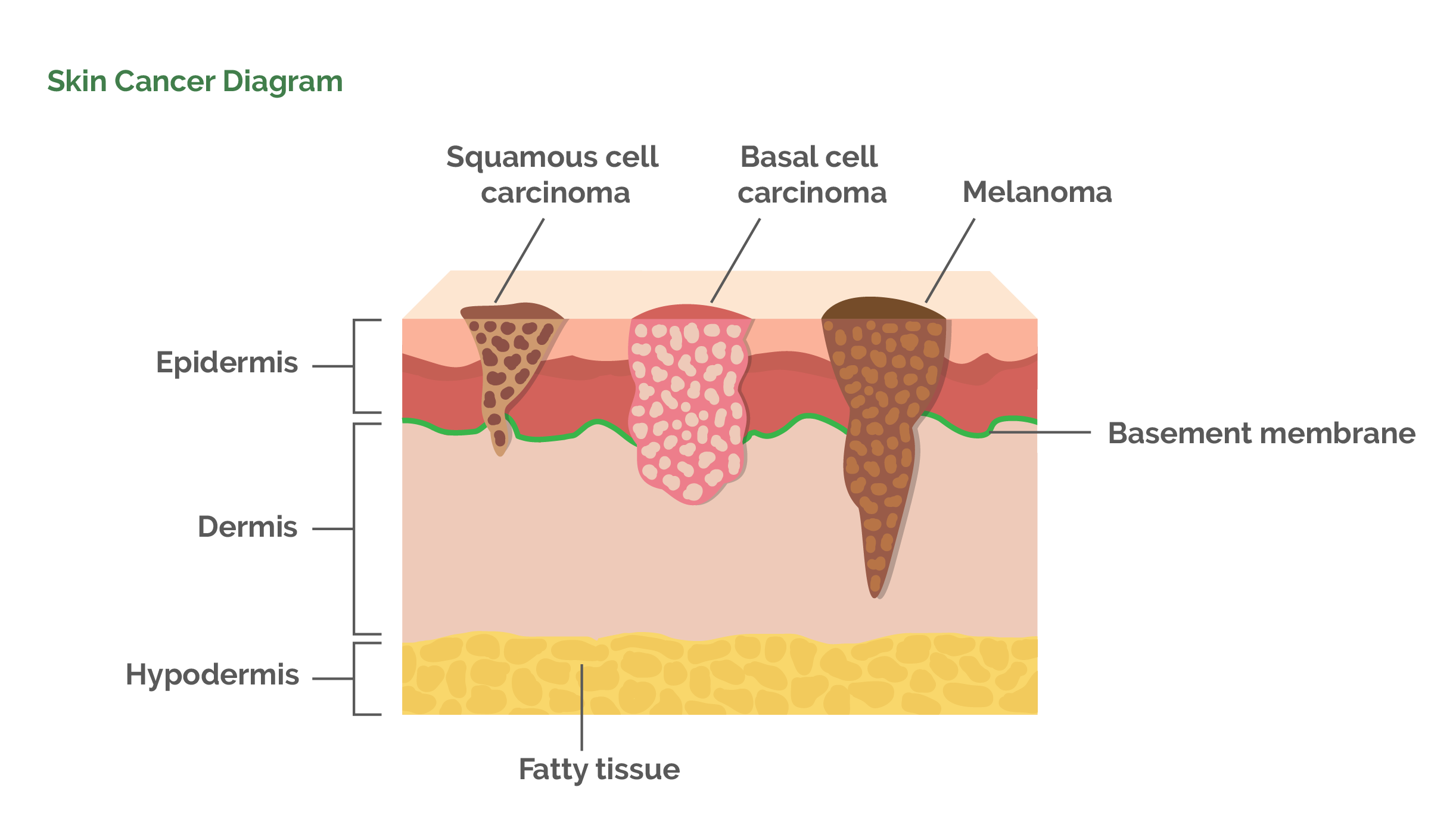 [DIAGRAM] Throat Cancer Diagrams - MYDIAGRAM.ONLINE